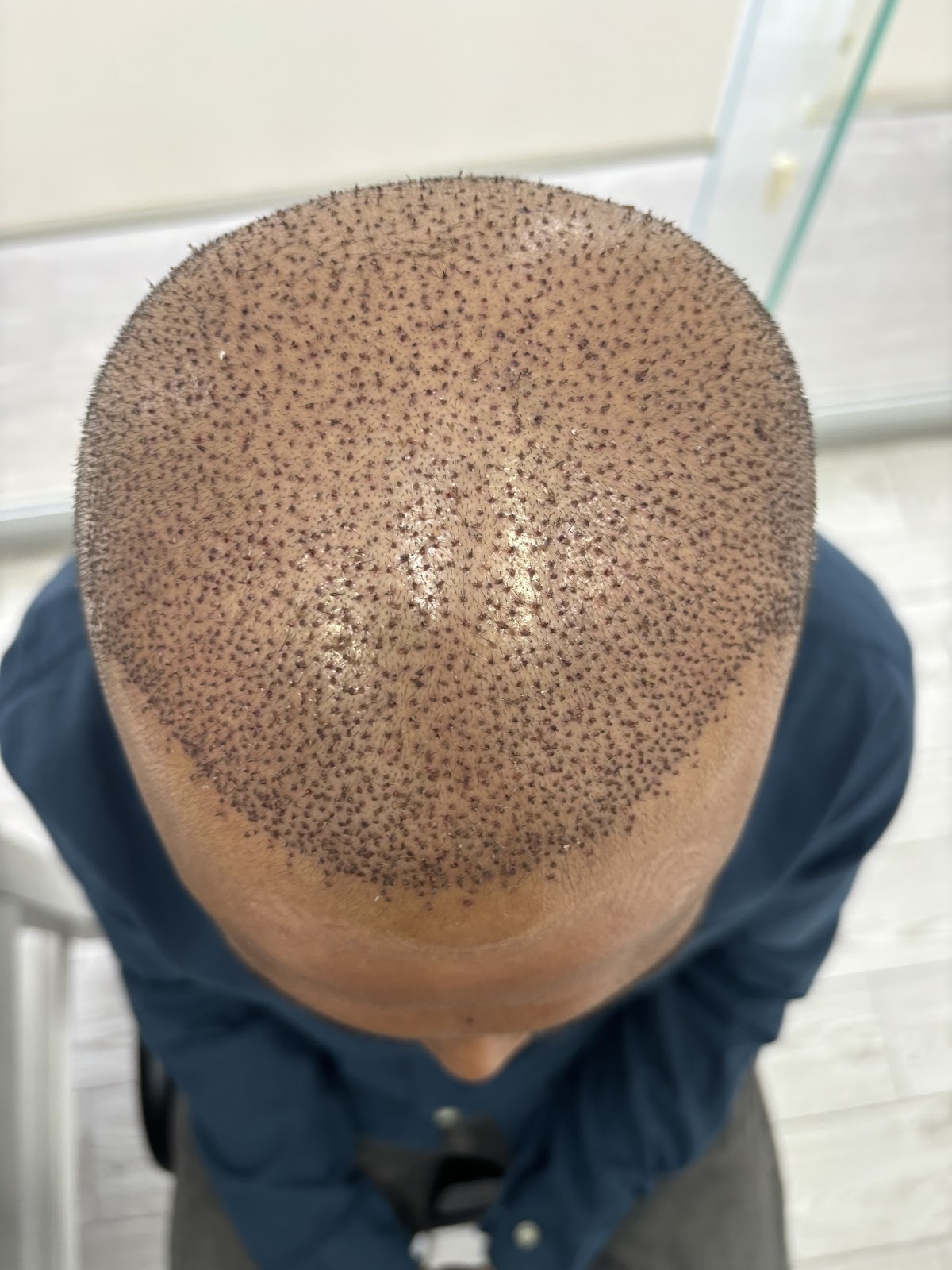 Hair Transplant Centers Cancun